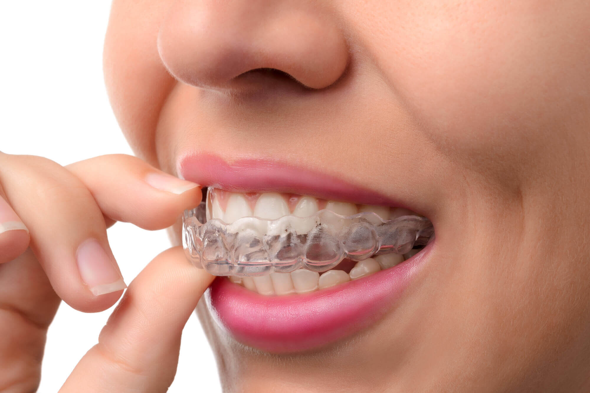 Invisalign Clear Braces