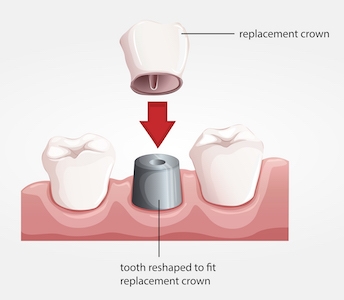 illustration of a dental crown