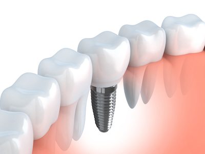 illustration of a dental implant