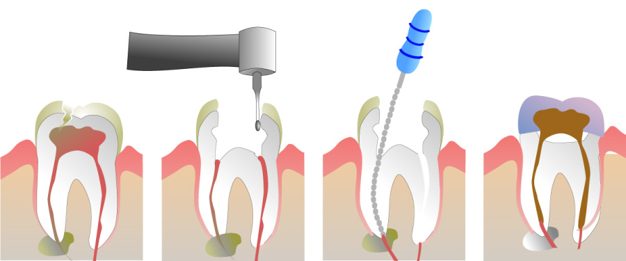 Graphic showing the steps for a root canal.