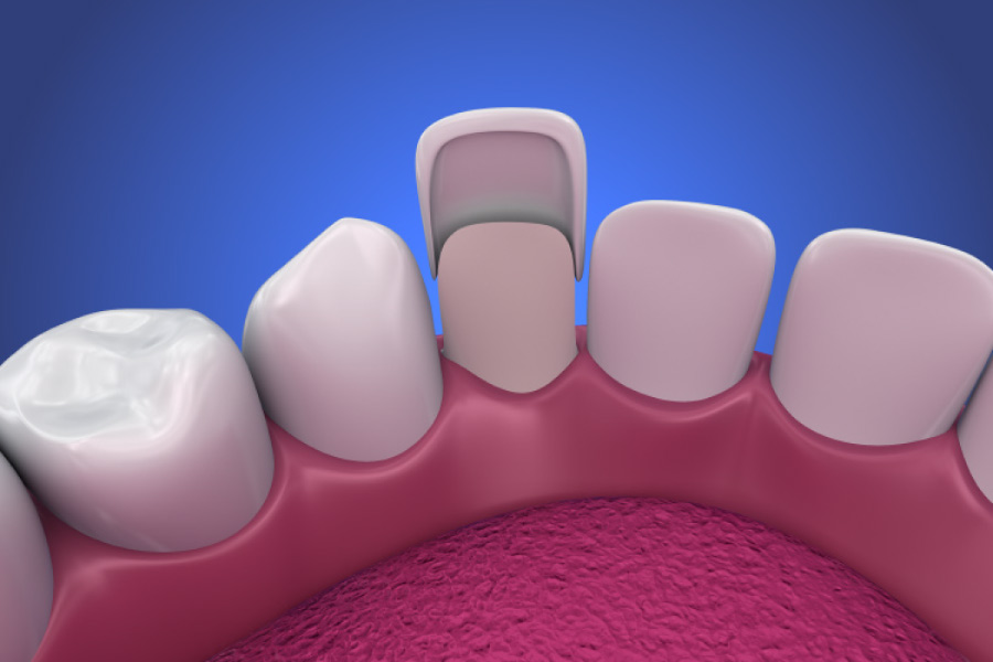 Model showing a porcelain veneer attached to the front of a tooth.