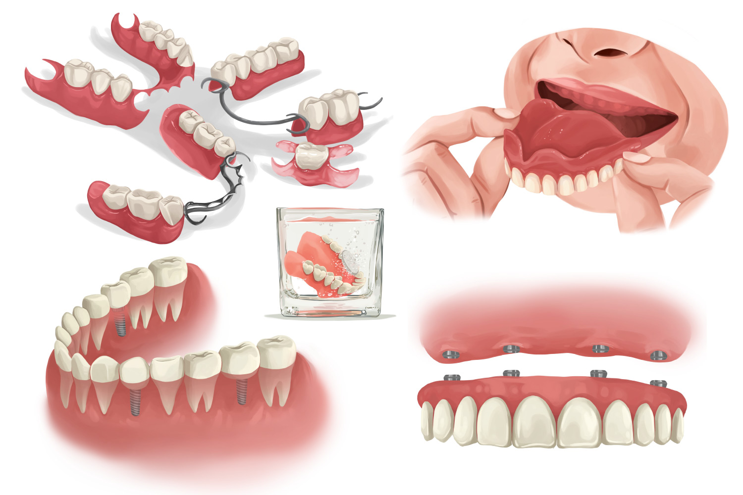 Illustrations of dentures vs. dental implants to replace missing teeth