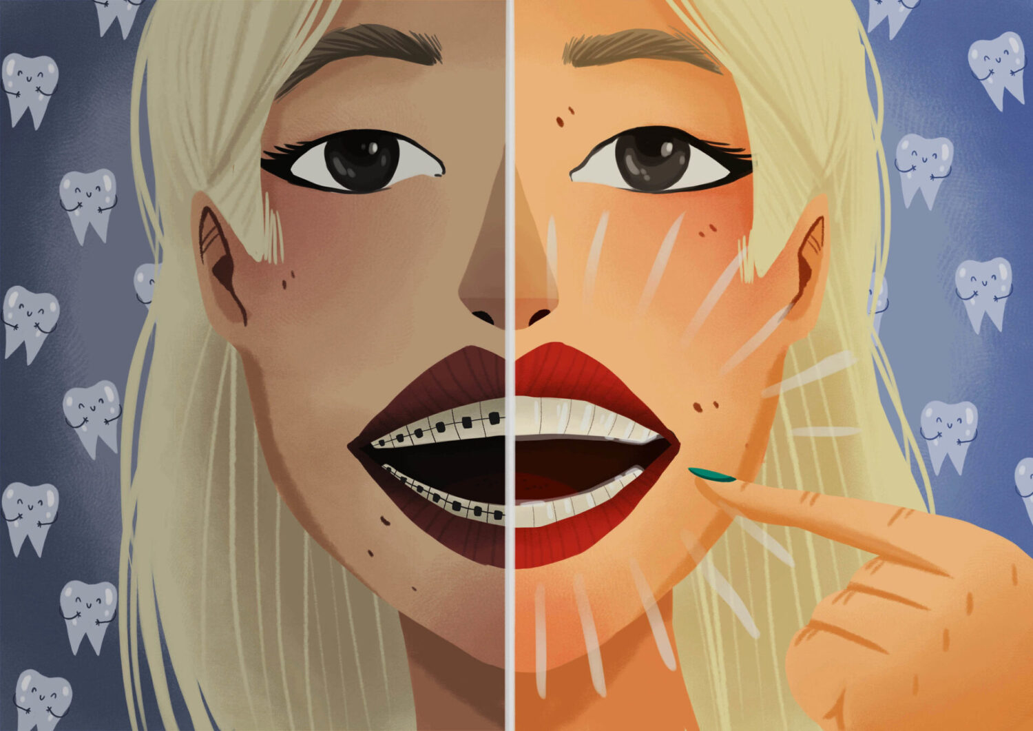 Graphic illustration comparing traditional braces and Invisalign.