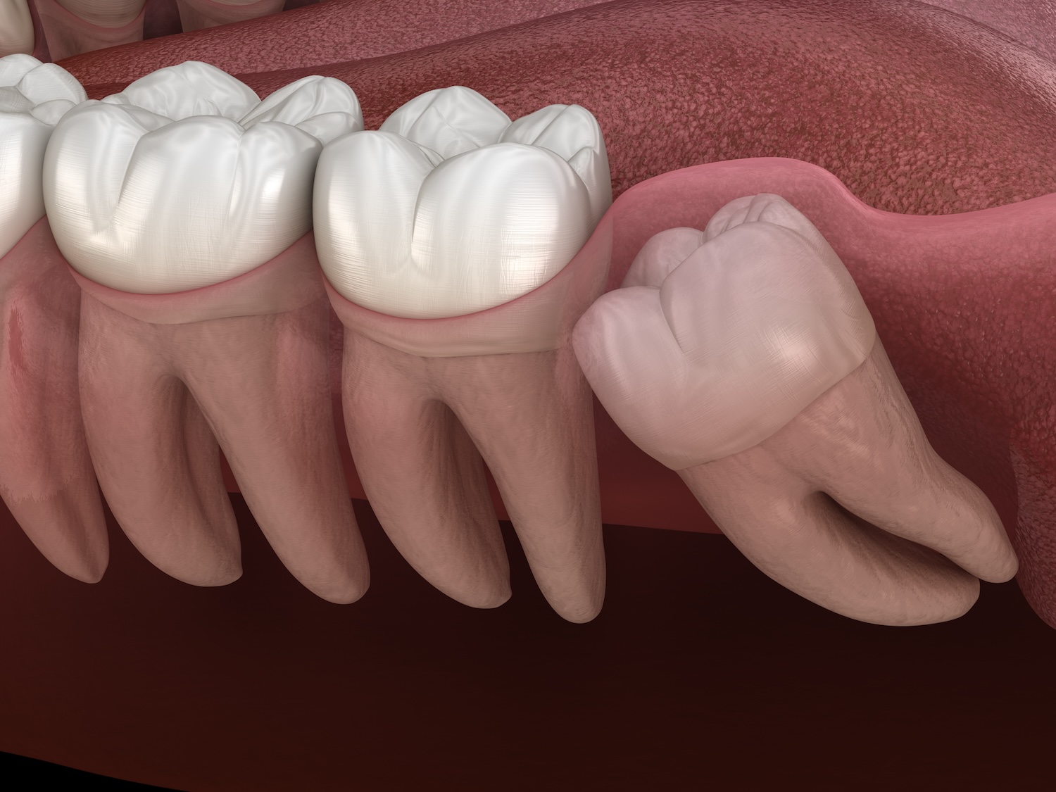 wisdom teeth removal, dental health Gastonia NC, wisdom teeth complications, Gastonia Family Dentistry, impacted wisdom teeth, dental check-ups