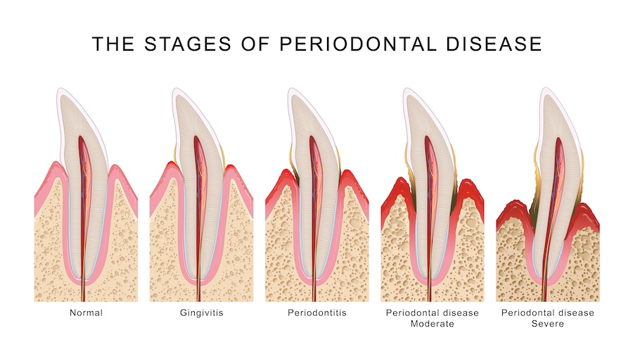stages of periodontal disease or gum disease